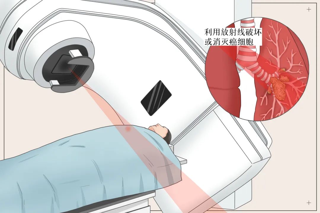 【高新轉載】放療適用于哪些腫瘤？