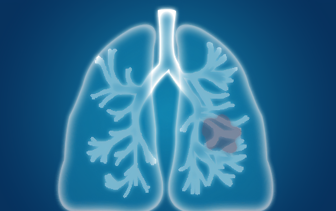 【高新轉(zhuǎn)載】為何肺癌發(fā)現(xiàn)即晚期，其實(shí)身體早已給你提示