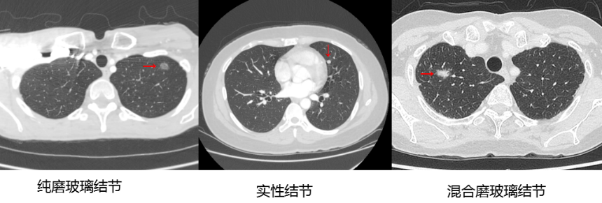 【高新轉載】肺結節(jié)與肺癌有的區(qū)別在哪呢？