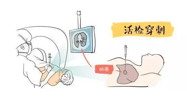 穿刺活檢是否會(huì)引起腫瘤細(xì)胞的擴(kuò)散轉(zhuǎn)移？