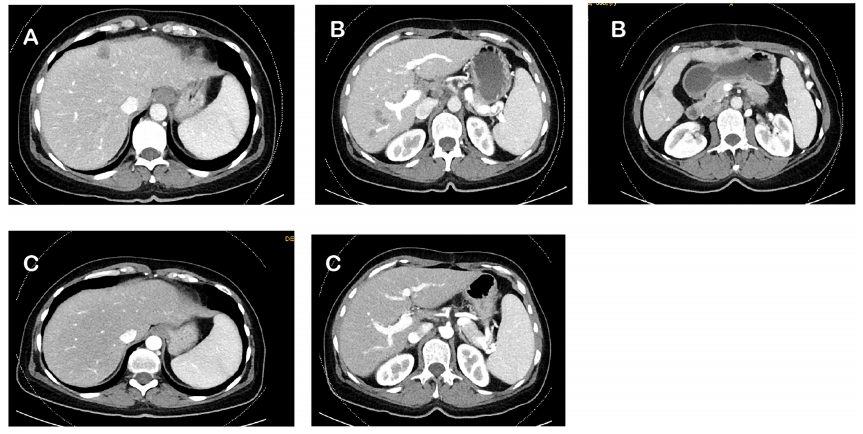 晚期癌癥從無藥可用到全部病灶消失，五年里她用了這三種藥
