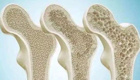 骨質(zhì)疏松不用怕，我院疼痛科為你解決疼痛