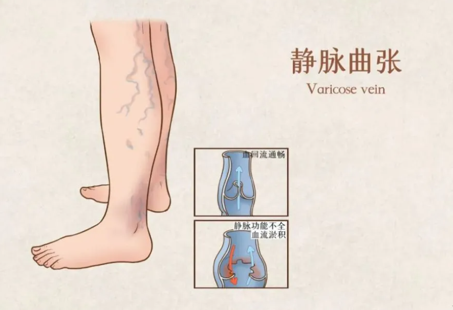 靜脈曲張不用開(kāi)刀，介入治療也能輕松處理