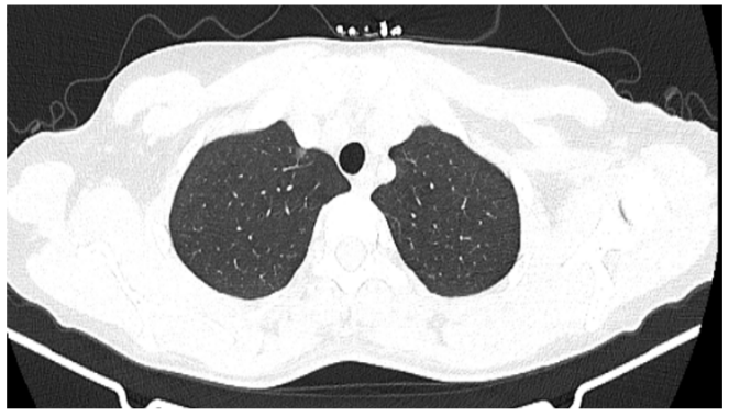 CT 提示肺結(jié)節(jié) 5 mm，手術(shù)還是觀察? 這 6 張表給出答案！