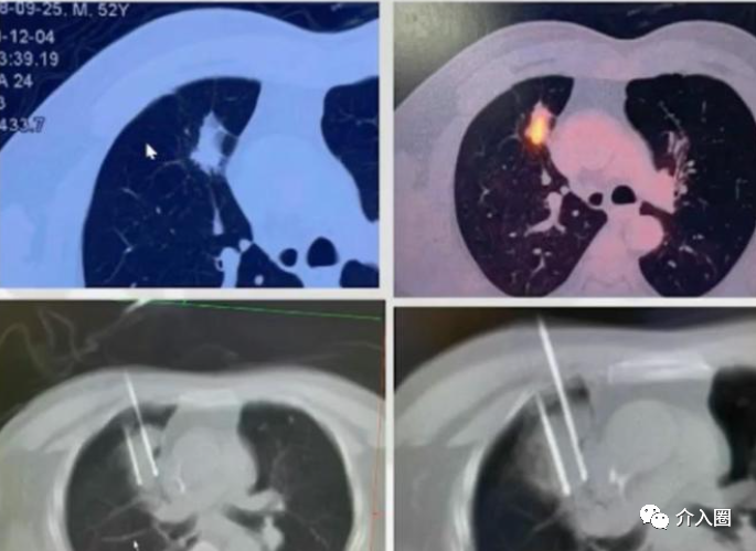 冷凍消融技術在肺癌治療中的應用