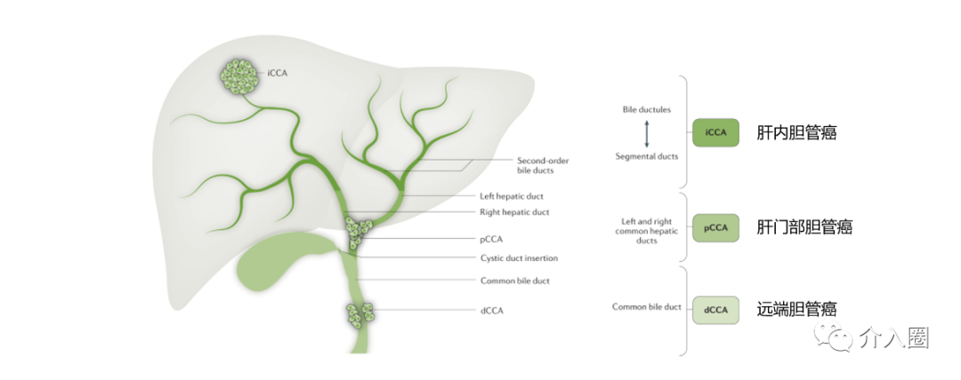 肝外膽管癌，介入治療大顯身手