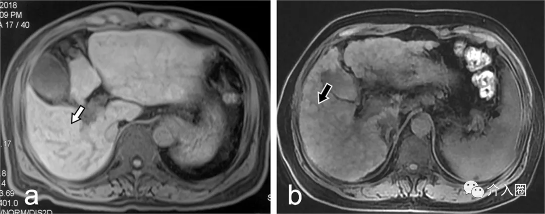 介入科醫(yī)生們，匯總好啦~患者術(shù)前術(shù)后須知