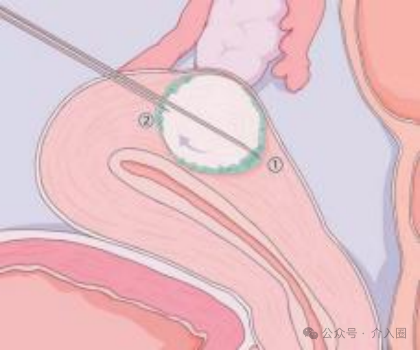 腫瘤介入治療——化學消融