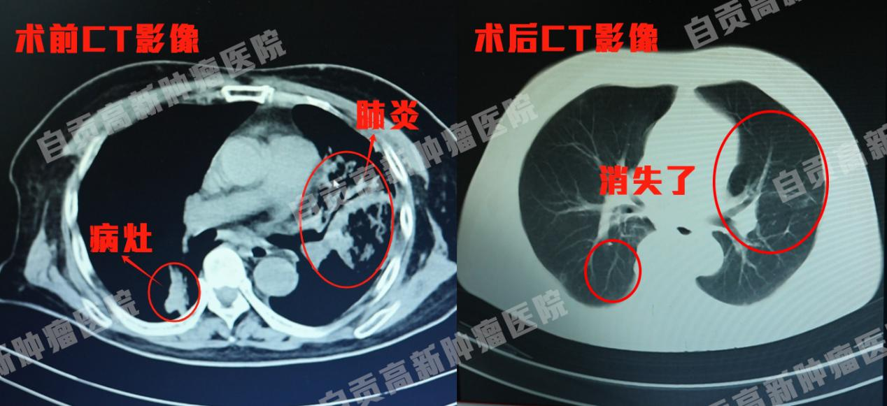 肺鱗癌伴上腔靜脈綜合征難阻生命步伐，介入治療讓患者重獲新生