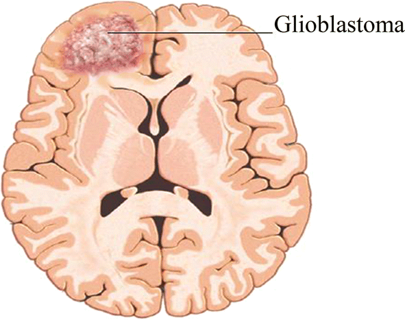 膠質(zhì)母細(xì)胞瘤的早期求救信號(hào)，千萬別忽略...