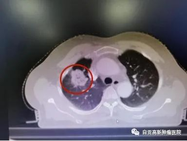【肺癌】肺癌三期難手術(shù)，超精細(xì)介入見(jiàn)奇效！