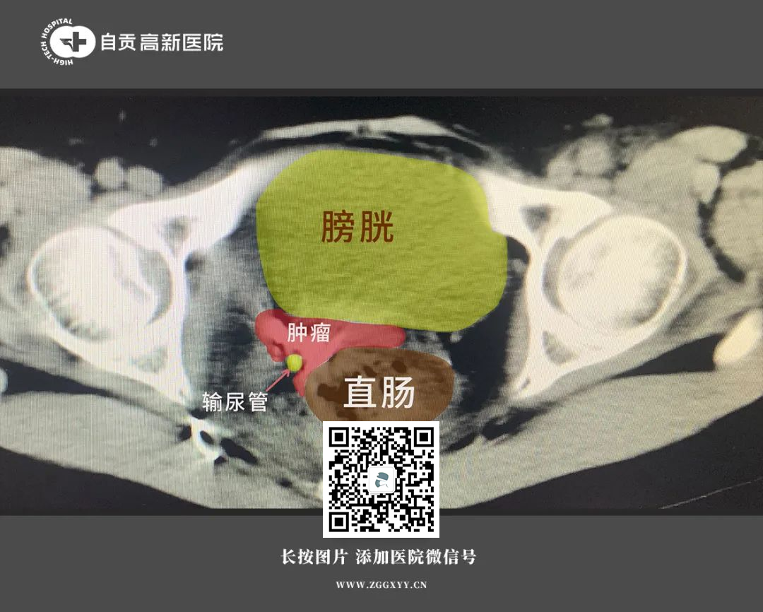 【宮頸癌】宮頸癌腫瘤復(fù)發(fā)壓迫多處器官，痛苦至極，介入治療快速縮小腫瘤！