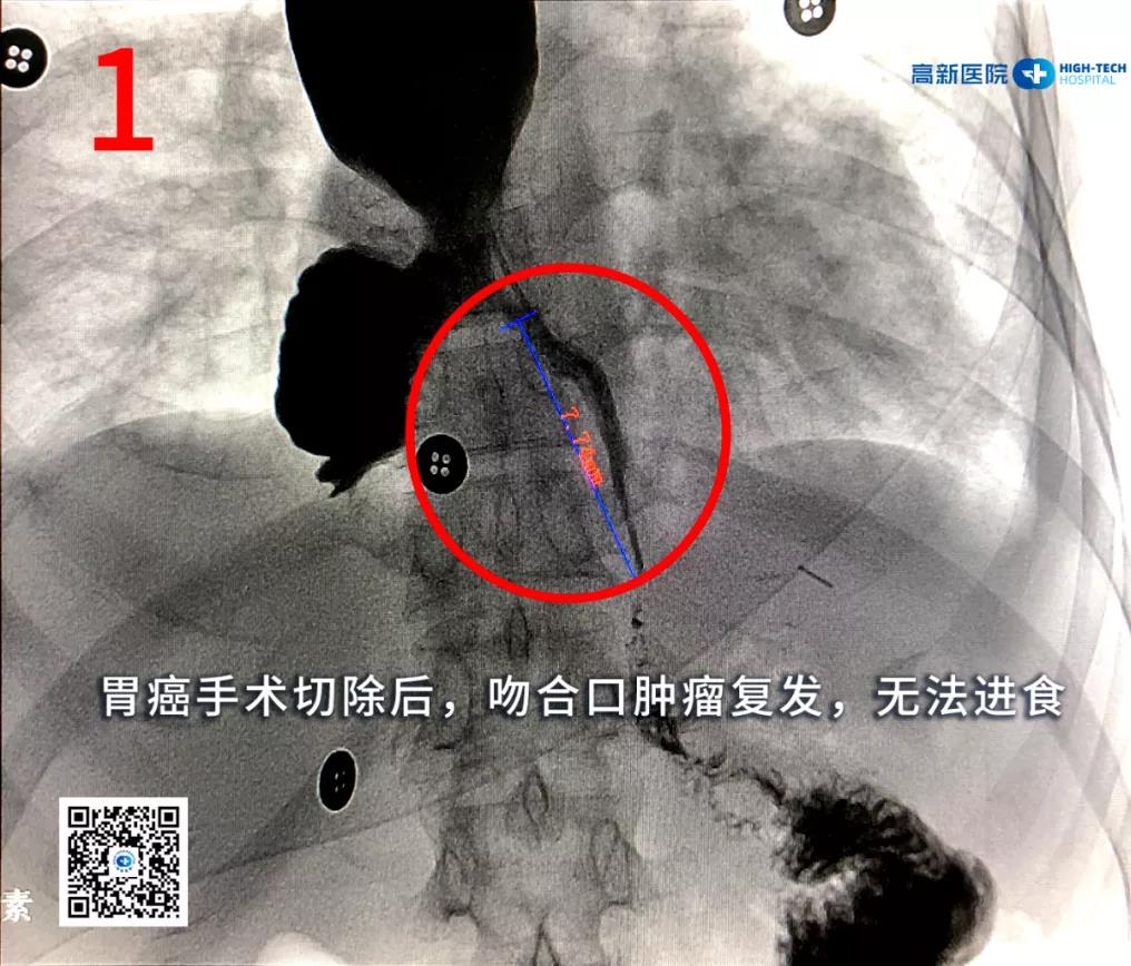 【胃癌】一位胃癌晚期患者從命懸一線(xiàn)到正常生活，幸運(yùn)絕非偶然！