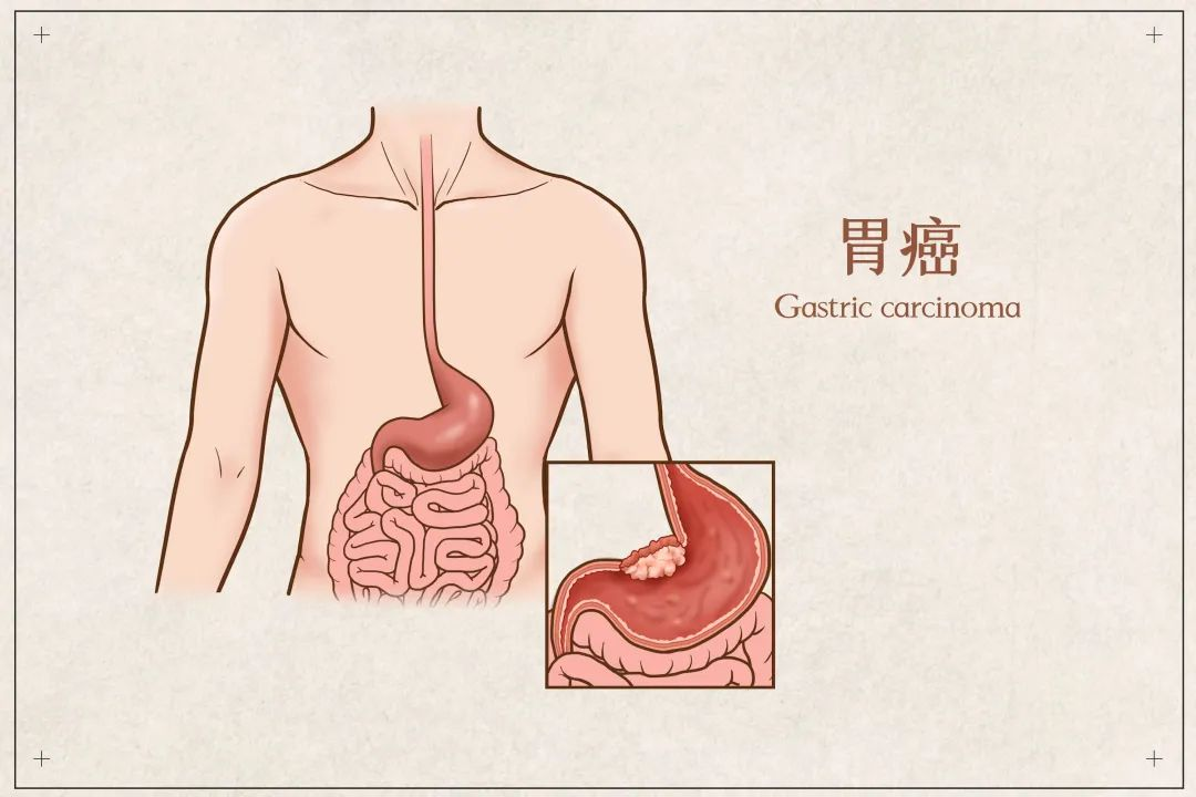 【胃癌復(fù)發(fā)全身骨轉(zhuǎn)移】多家醫(yī)院放棄治療，3次介入2個(gè)月重獲新生